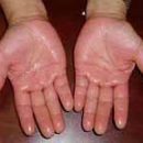 excessive sweating of palms