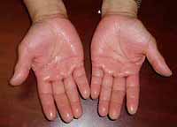 excessive sweating of palms