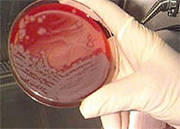 Anthrax Symptoms and Treatment