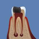 treatment of periodontitis