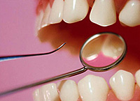 Visningar av periodontit