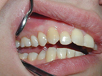 O que é periodontiaches