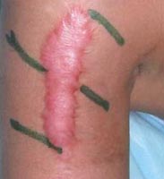 scar removal