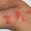 diagnosis and treatment of scabies