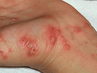 Scab: diagnosis and treatment