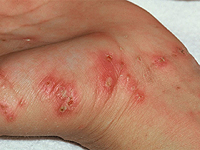 Scab: diagnose en behandeling