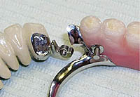 Modern view of the dentures