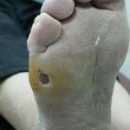 fungal diseases of the skin feet