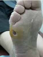 fungal diseases of the skin feet