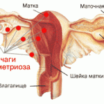 Парацервикальные кисты — ginekola.ru Foto 16