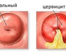 cervicitis or cervical inflammation
