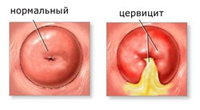 cervicitis or cervical inflammation