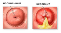 Cervicit eller inflammation i livmoderhalsen