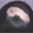 Alopecia areata that do
