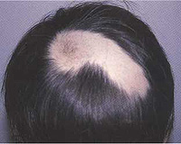 Focal baldness. What to do