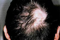 Focal baldness. What to do