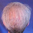 diffuse alopecia what it is