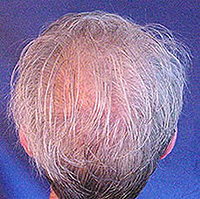 Alopecia diffusa. Cos'è