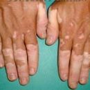 mysterious disease vitiligo