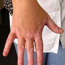 Vitiligo skin disorder of pigmentation