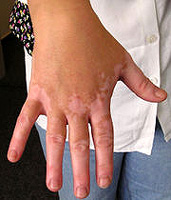 Vitiligo - Hudpigmenteringsbrudd