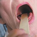 chronic tonsillitis treatment without removal of the tonsils