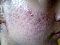 Metode suzbijanja Tick Zheleznille acne