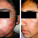 Elos acne treatment 2