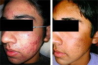 Elos acne treatment 2