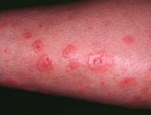 protracted conflicts lead to eczema