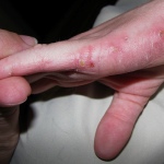 Екземата е най-често срещаното кожно заболяване