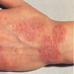 Juntamente com eczema