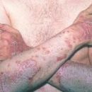 psoriasis and family