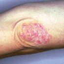 What is psoriasis and can it be treated