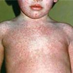 And we have quarantine! Measles