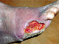 types of venous ulcers