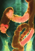 Diverticolosi del colon: diagnosi e trattamento