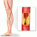 examination and treatment of atherosclerosis obliterans of lower