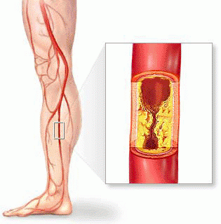 examination and treatment of atherosclerosis obliterans of lower