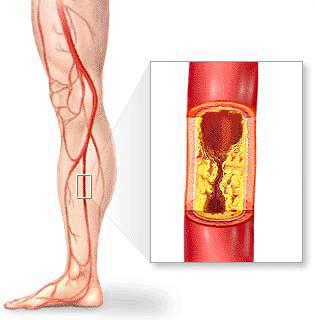 Vyšetření a léčba obliterující aterosklerózy dolních končetin