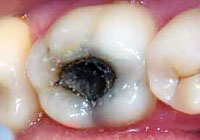 Chronic deep caries: causes and course of illness