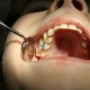 chronic middle caries option dental tissue destruction