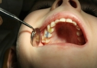 chronic middle caries option dental tissue destruction