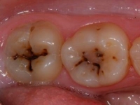 About the methods of treating caries